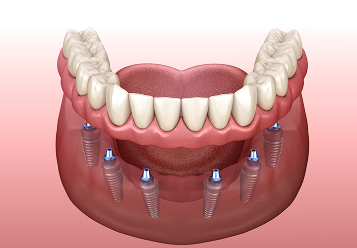 Σταθεροποίηση Οδοντοστοιχίας