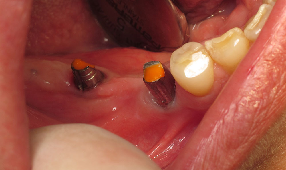 Χειρουργική Επέμβαση Εμφυτεύματος