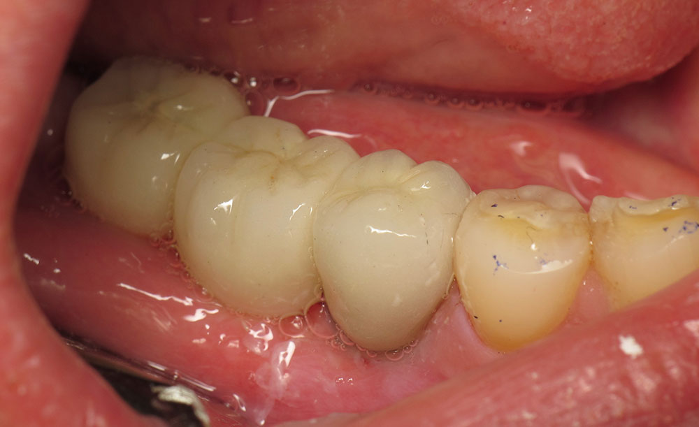 Χειρουργική Επέμβαση Εμφυτεύματος